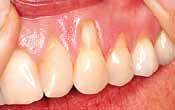 over tooth roots and mucoderm Clinical