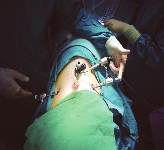The first succesfull laparoscopic nephrectomy was described by Clayman et al. in 1991 [2].