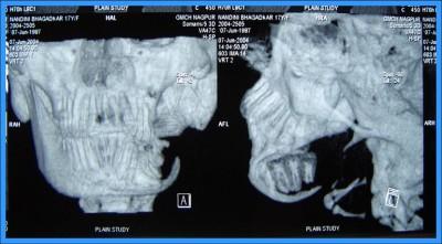 dimentional recostruction on ct scan showing