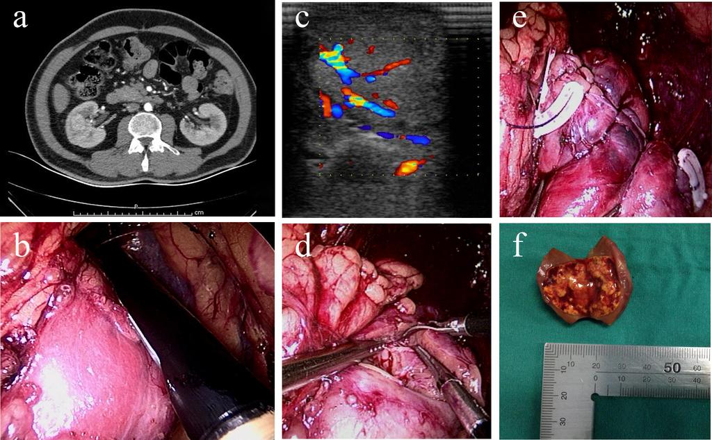 Intraoperative ultrasonography in LPN for intrarenal tumors Fig 1. (a) Preoperative CT showing a TIT in right kidney. (b) Screen capture of ILUS with a probe scanning the kidney.