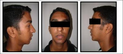 Figure 3 Figure 3: Post operative front and lateral profile photographs of the patient.