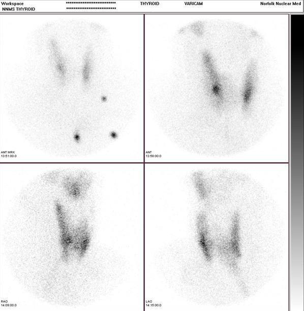 Thyroid Scan After injection of a radioactive substance, a