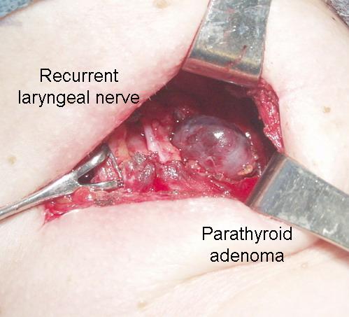 Parathyroidectomy Excision of one or more of the