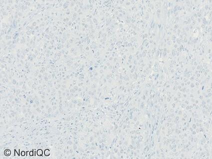 4b Insufficient ER staining of the breast ductal carcinoma no. 6 with expected 60-80% cells positive using same protocol as in Figs. 1b - 3b.