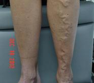 lower limb veins that developed with her 1 st pregnancy and have been progressively increasing in