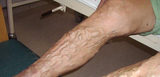 Chronic venous insufficiency (CVI) is because a major