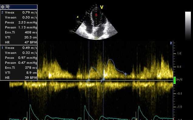 MR Case E wave 1,1 m/sec No systolic reversal in pulmonary