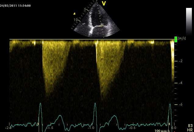 CW Doppler In severe MR Dense MR signal Early peak Triangular contour