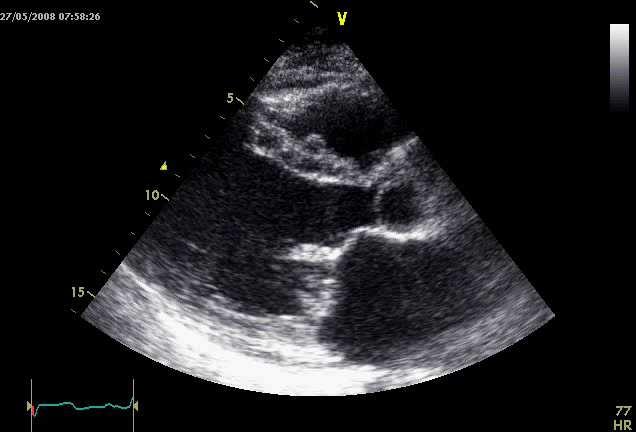 perforation (endocarditis) Congenital abnormalities Type II Excessive leaflet mobility