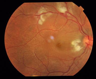 One patient had an atypical presentation of bilateral papillitis without any retinitic patches.