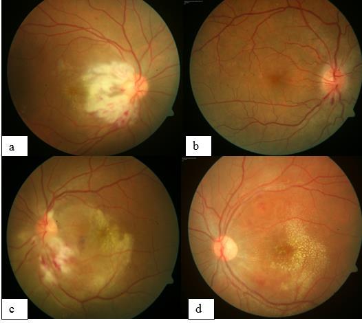 1: Severe bilateral post-typhoidneuroretinitis with retinitic patches and neurosensory detachment at macula(associated with high Widal
