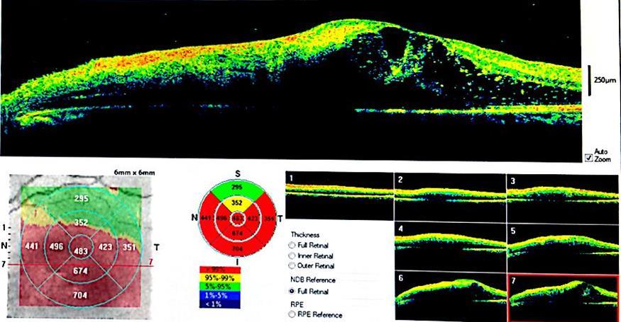 Fig. 3: Optical Coherence Tomography showing neurosensory detachment On evaluating the response to steroids for the above mentioned duration, all 14 patients responded positively in a variable manner.