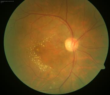 region in cases with severe macular involvement. This favourable response to systemic steroids points towards an underlying immunological mechanism for this entity. Fig.