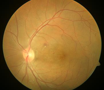 patients with less severe disease had equivocal Widal titres. For correlation of widal titres with ocular disease severity extent of fundal lesions, visual acuity and laterality were considered.