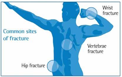 Focus on: Osteoporosis keeping bones healthy can prevent fractures in later life Osteoporosis is often thought of as a condition that mainly affects women.