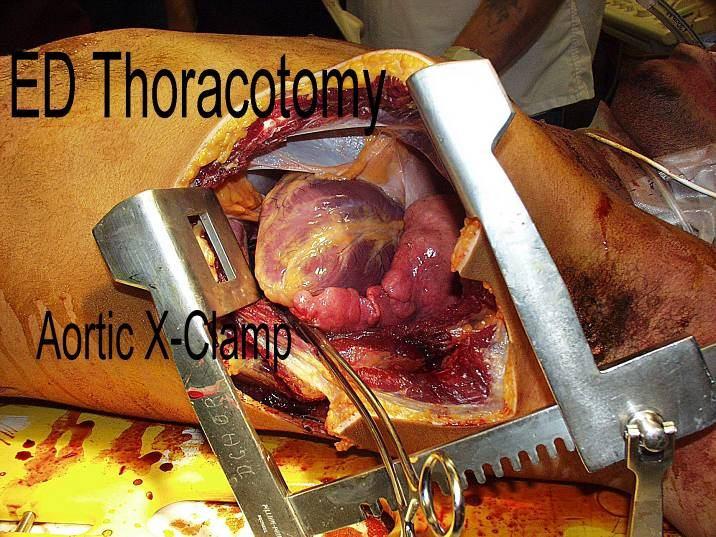 Circulation: Management ED Thoracotomy: penetrating torso <