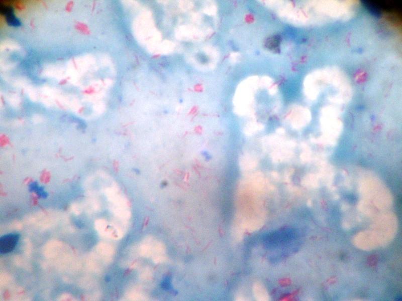Fig.4 Slit skin smear showing Acid Fast Mycobacterium leprae bacilli. V.