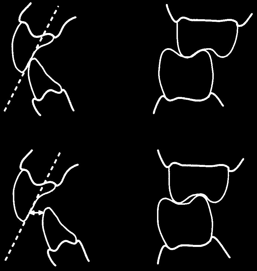 THE JOURNAL OF PROSTHETIC DENTISTRY OLTHOFF ET AL A Fig. 3. Two conditions set for OGP crown fabrication. 1. OGP-, contact of front teeth; 2. OGP+, long centric occlusion of 1 mm.