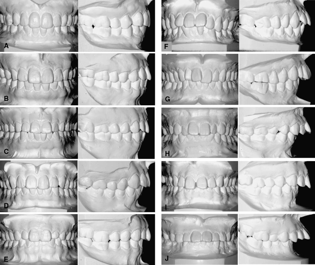 American Journal of Orthodontics and Dentofacial Orthopedics Kuroda et al 341 Volume 137, Number 3 Fig 1. Dental casts of 10 subjects with untreated maxillary protrusion.