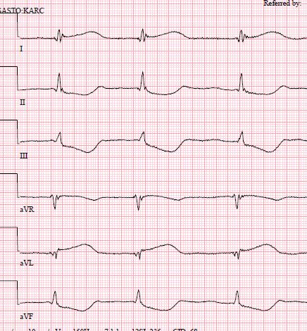 STEMI that could be misdiagnosed as