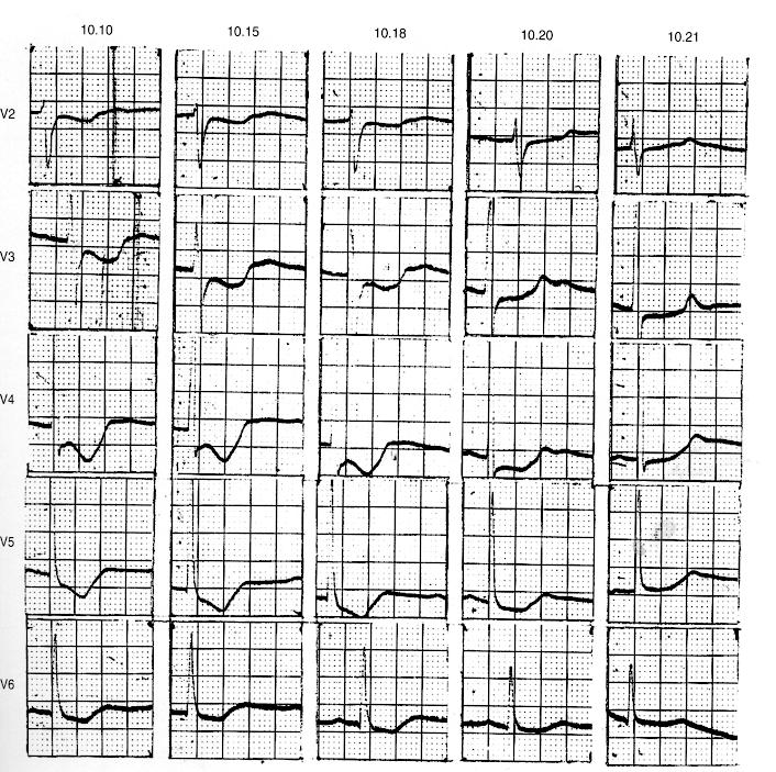 Electrocardiography of acute