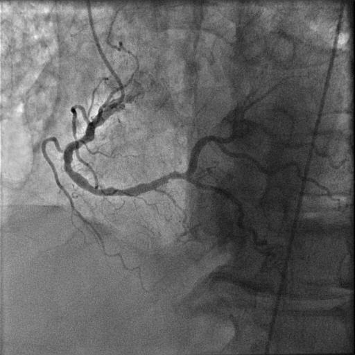 LAD occluded (stent thrombosis) Post-PCI RCA