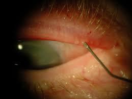 gland probing Exposure: eyelid surgery