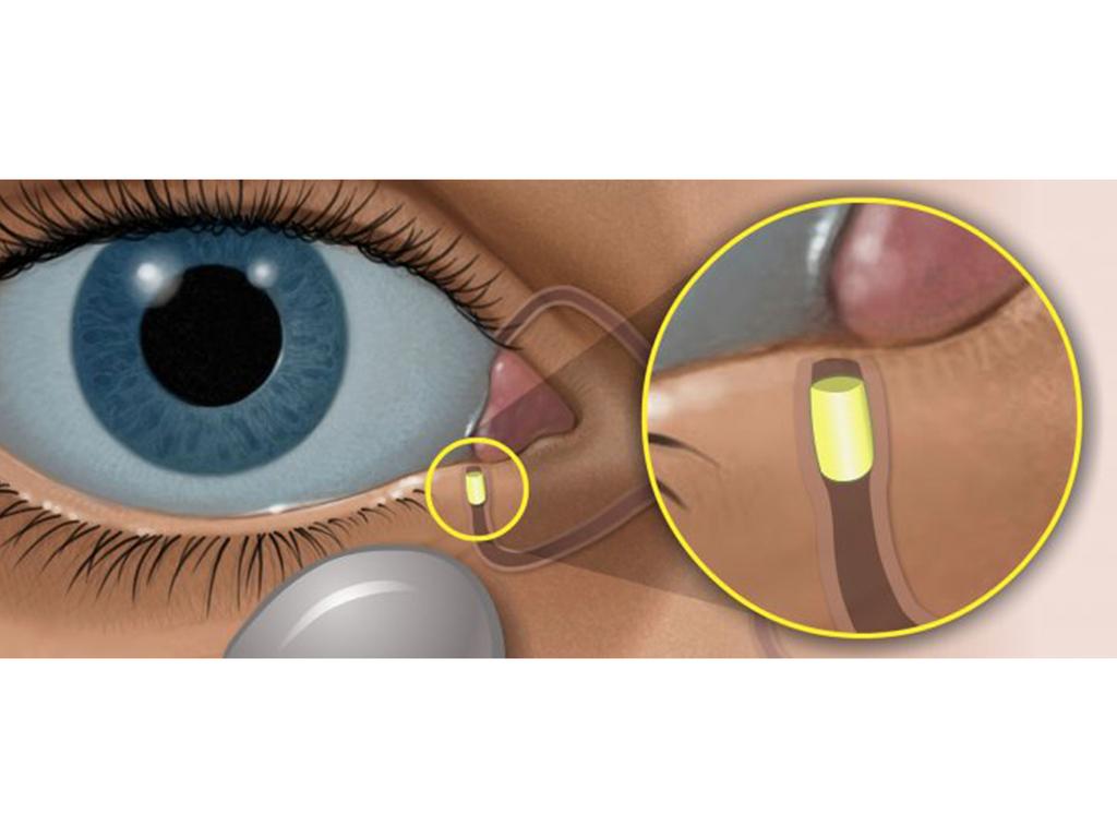 Treatments on the Forefront Dextenza: a sustained-release dexamethasone loaded punctual plug, resorbs slowly over 30days. FDA approved December 2018 for post-operative ocular pain/inflammation.