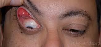 dysfunction Blepharitis is chronic and inflammation can
