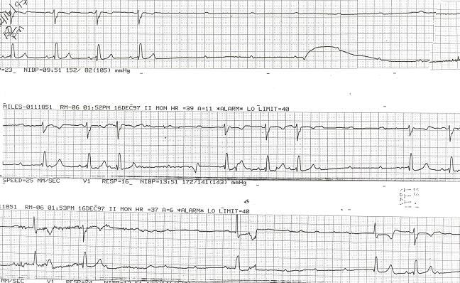 LBBB to