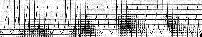 Ventricular tachycardia Rate > 100bpm Regular,