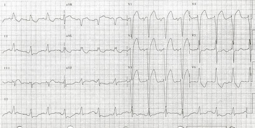 Baseline EKG p
