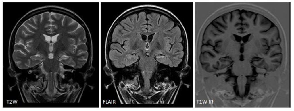 Fig. 2: A 23-year old woman with a hipocampal sclerosis in the left temporal lobe.