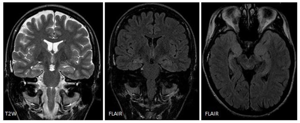 5: A 47-year old man with a hipocampal atrophy and sclerosis in the