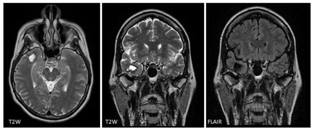 Fig. 6: A 46-year-old woman with a gliosis and