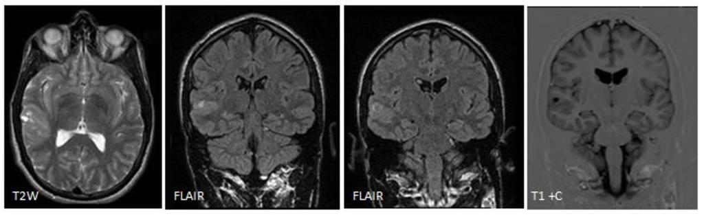 Fig. 8: A 32-year old woman with a dysembryoplastic neuroepithelial tumor (DNET) in the right temporal lobe.