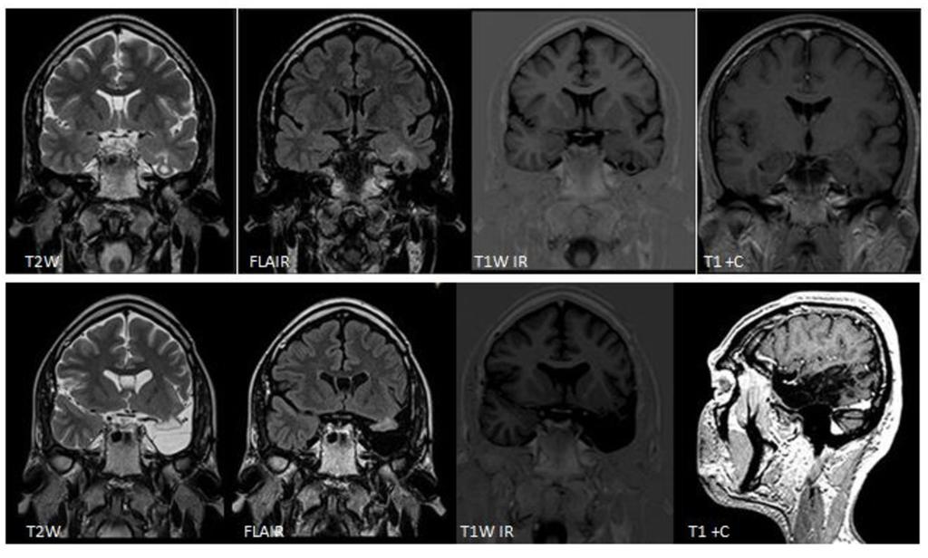 9: A 48-year old woman with a dysembryoplastic neuroepithelial tumor (DNET) and cortical dysplasia in the right temporal lobe. Fig.