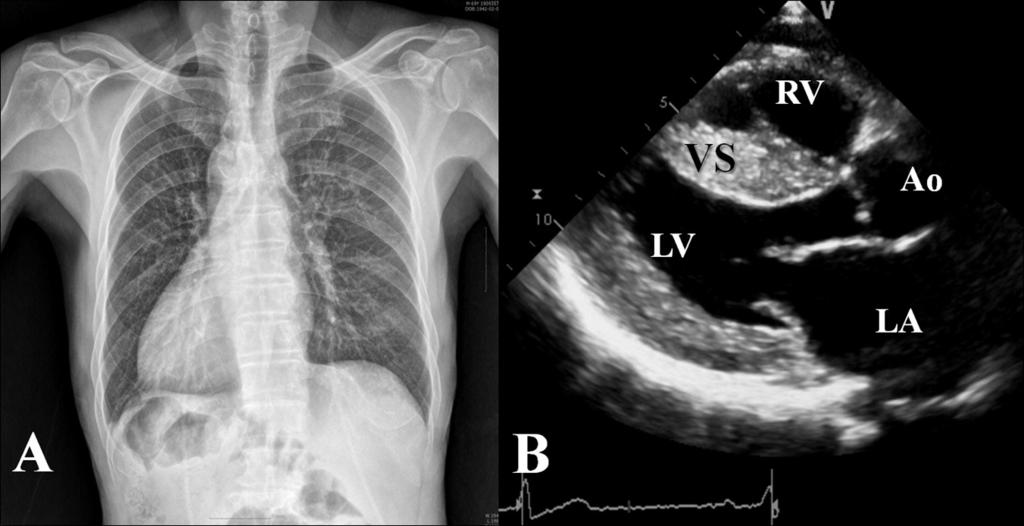 Su Young Jang, et al: AMI in Dextrocardia and Hypertrophic Cardiomyopathy Fig. 3. (A) Chest radiograph reveals right-sided heart and stomach gas suggesting situs inversus totalis.