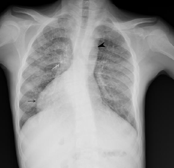 In the present case, 17 year old adolescent male with right isomerism presented with dysphagia, cough and episodes of breathlessness, central cyanosis and clubbing.