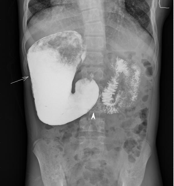Jejunal loops are seen predominantly on the left side of the abdomen (straight arrow).