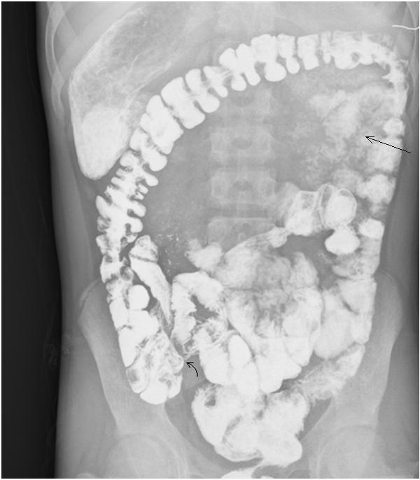 Upper GI Barium series with Barium sulphate suspension shows stomach placed in the left sub-hepatic region (arrow).