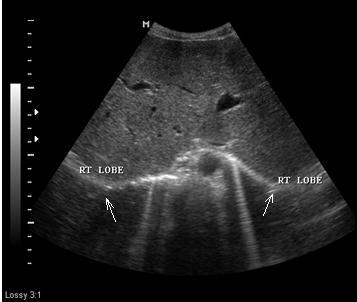 Figure 5: A 17 year old male with right Isomerism presenting with dysphagia.
