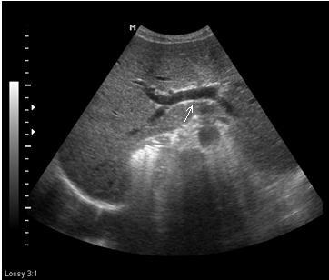 (Protocol: Medison, SA8000, 3-7 MHz, curvilinear probe) Figure 6: A 17 year old male with right Isomerism presenting with dysphagia.