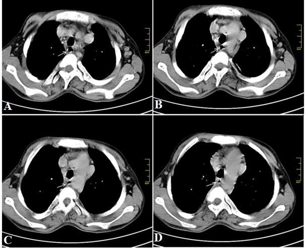 Figure 10: A 17 year old male with right Isomerism presenting with dysphagia. Non contrast axial CT of the thorax in mediastinal window.