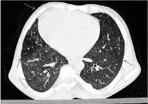 (Protocol: Siemens Somatom, dual slice CT at 90mAs and 130kV, 5mm slice thickness, non contrast). Figure 11: A 17 year old male with right Isomerism presenting with dysphagia.