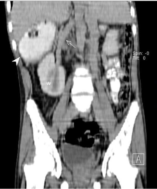 (*). (Protocol: Siemens Somatom, dual slice CT at 96 mas and 136kV, 5 mm slice thickness, contrast enhanced with oral contrast 500 ml 2% diluted Omnipaque, and intravenous 60