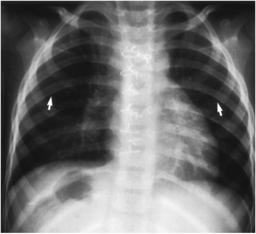The pulmonary atrium is on the right with a right-sided bilobed lung, stomach, single spleen, and aorta. The cardiac apex is on the right. Situs inversus is seen in 0.