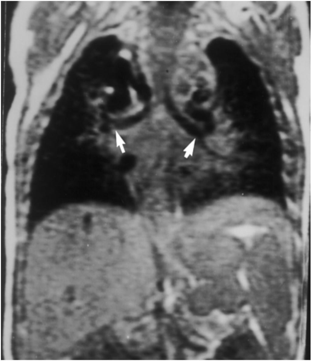 38 Figure 6: Polysplenia with hyparterial bronchia and bilobed lung Figure 7: Interruption of Inferior Vena Cava with