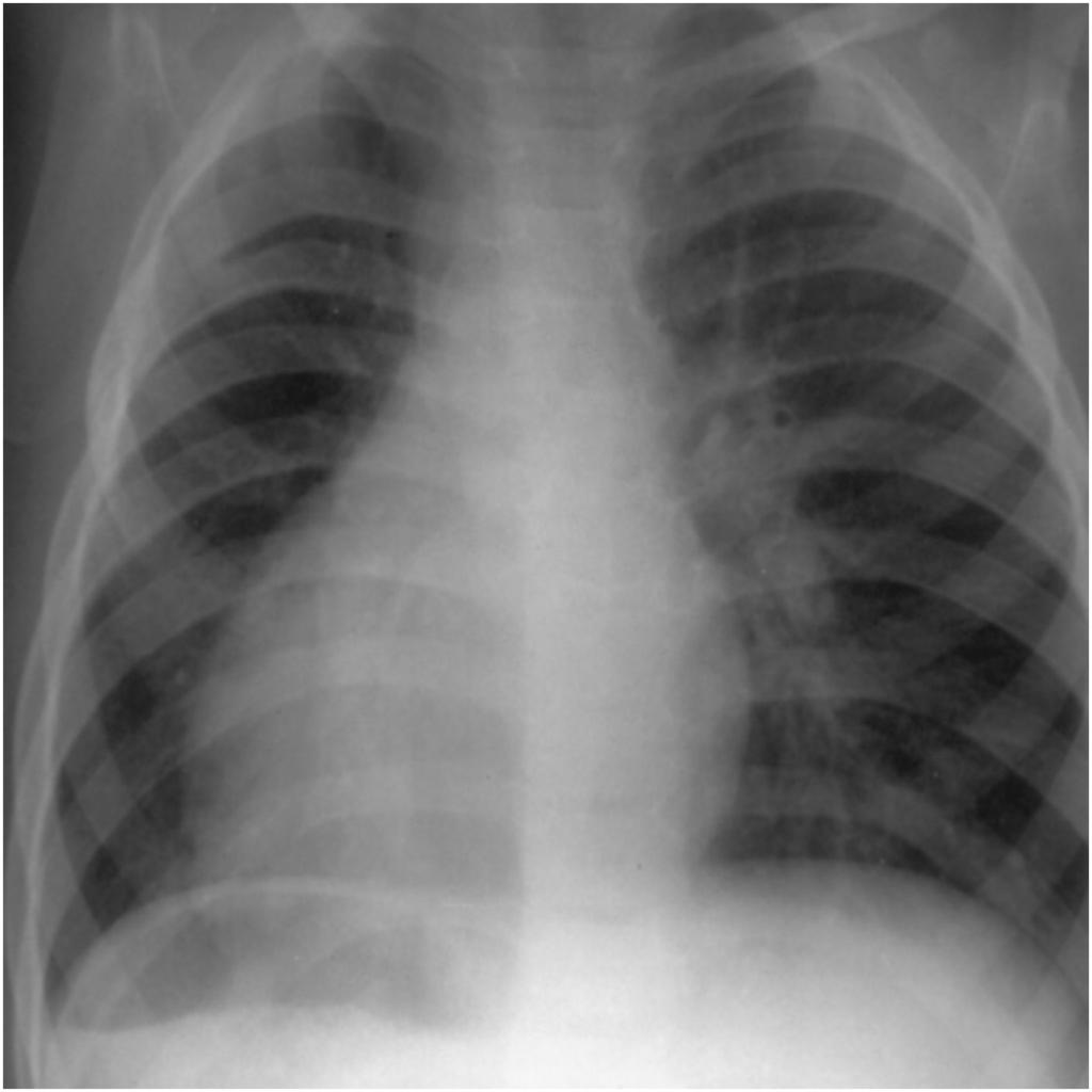 Figure 14: Polysplenia These anatomic structures may be evaluated with chest radiography, ultrasonography (US), CT, MR imaging, and angiocardiography, although the last study is now rarely necessary