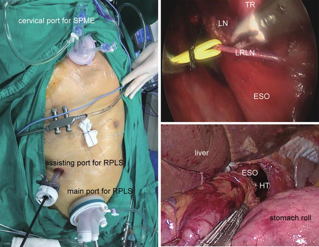 E380 Lu et al. A new method of minimally invasive esophagectomy A B C Figure 2 Intraoperative picture of the case undergoing TPMLE.